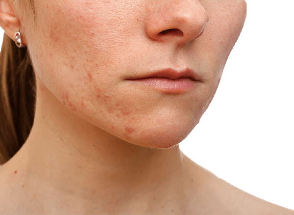 acne on chin and cheeks
