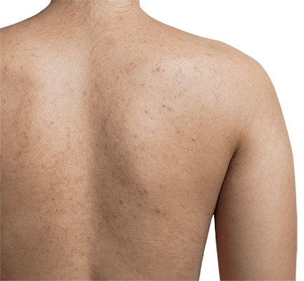 acne scared back