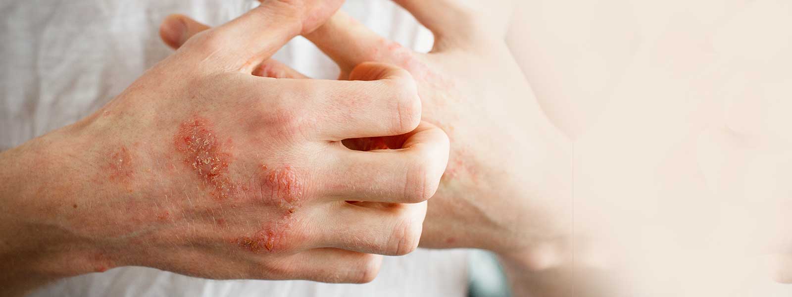 eczema relief banner