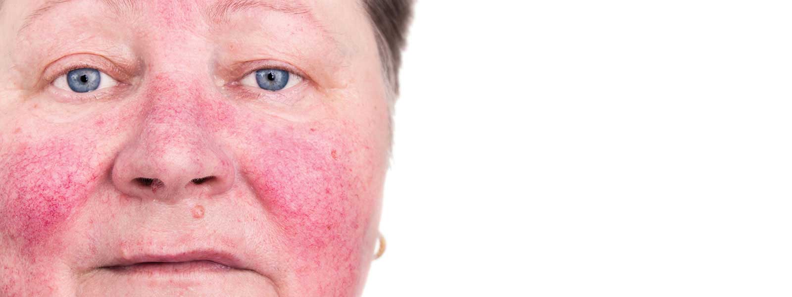 Facial redness