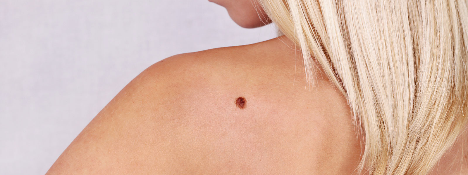 skin cancer treatment