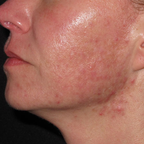 acne laser therapy before