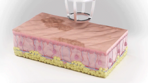 Co2 Laser Video
