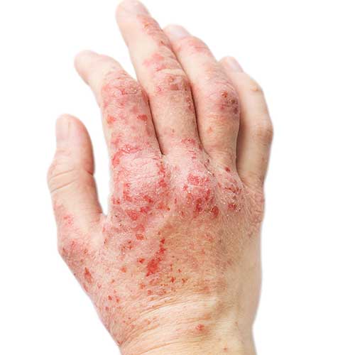 before eczema treatment