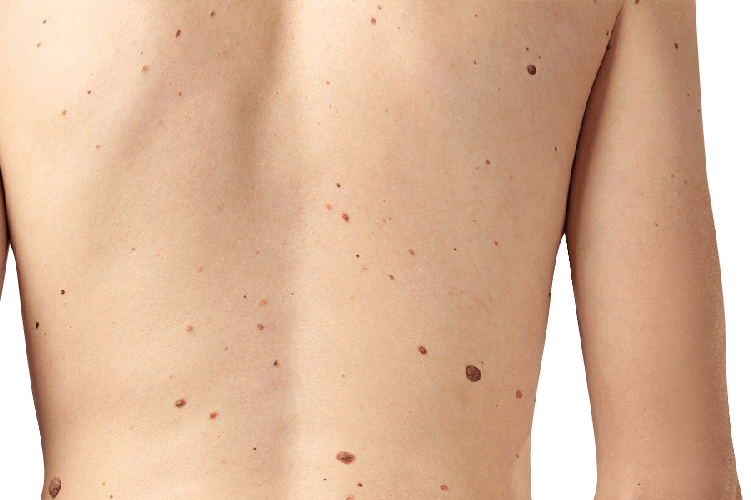 Mole removal treatment