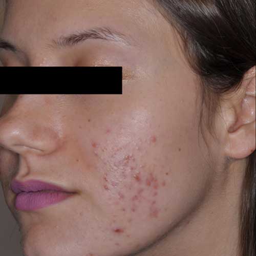 Sebacia 22 year old female before