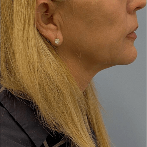 sofwave laser after