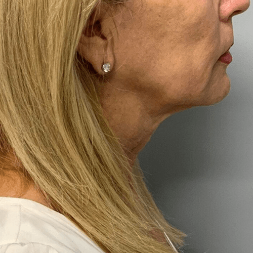 sofwave laser before