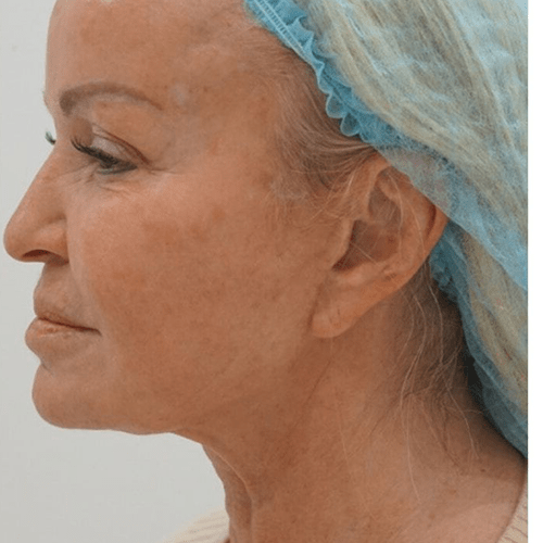 sofwave after treatment