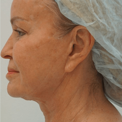 sofwave before treatment